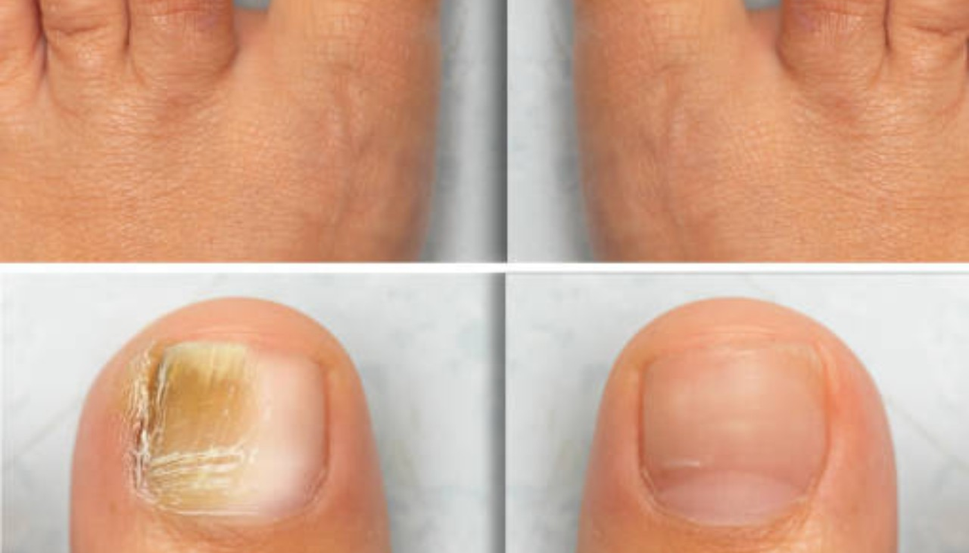 Fungal Nails guides