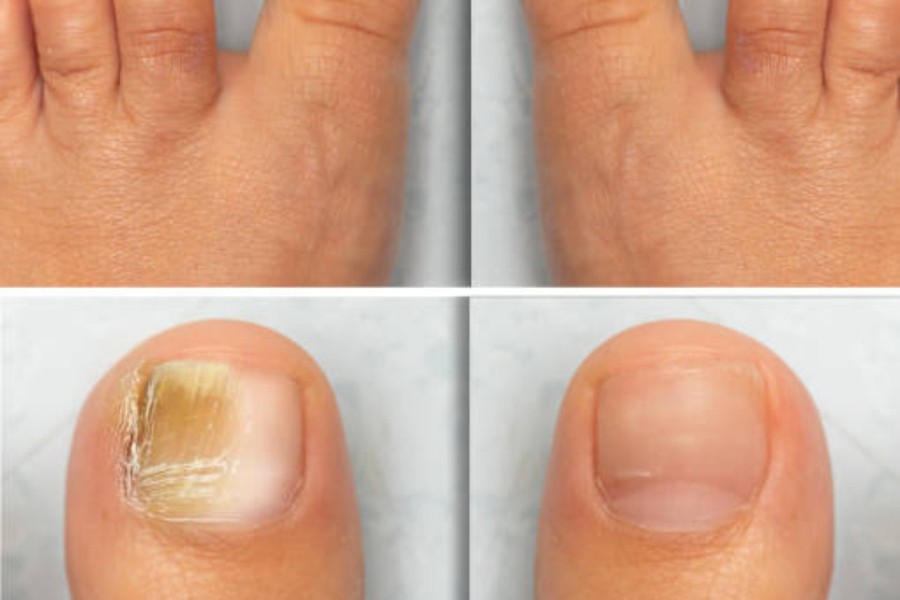 Nail care